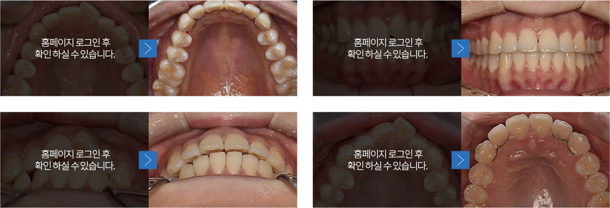 치아교정 전후 사진